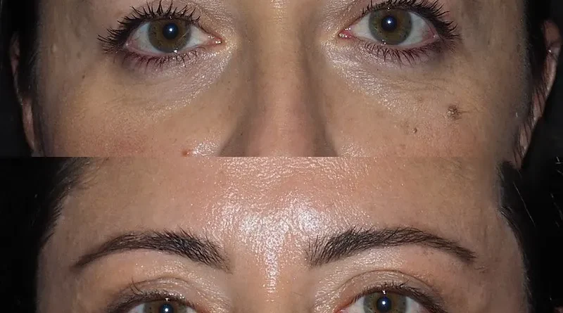 Eye Bag Removal