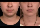 double chin removal