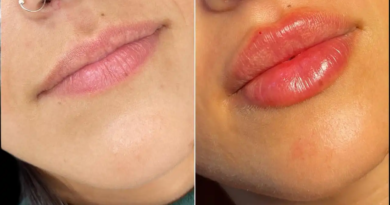 Juvederm fillers