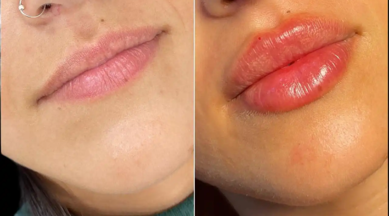 Juvederm fillers